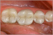 Tooth-colored Fillings After