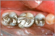 Tooth-colored Fillings Before