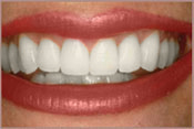 Tooth Whitening After